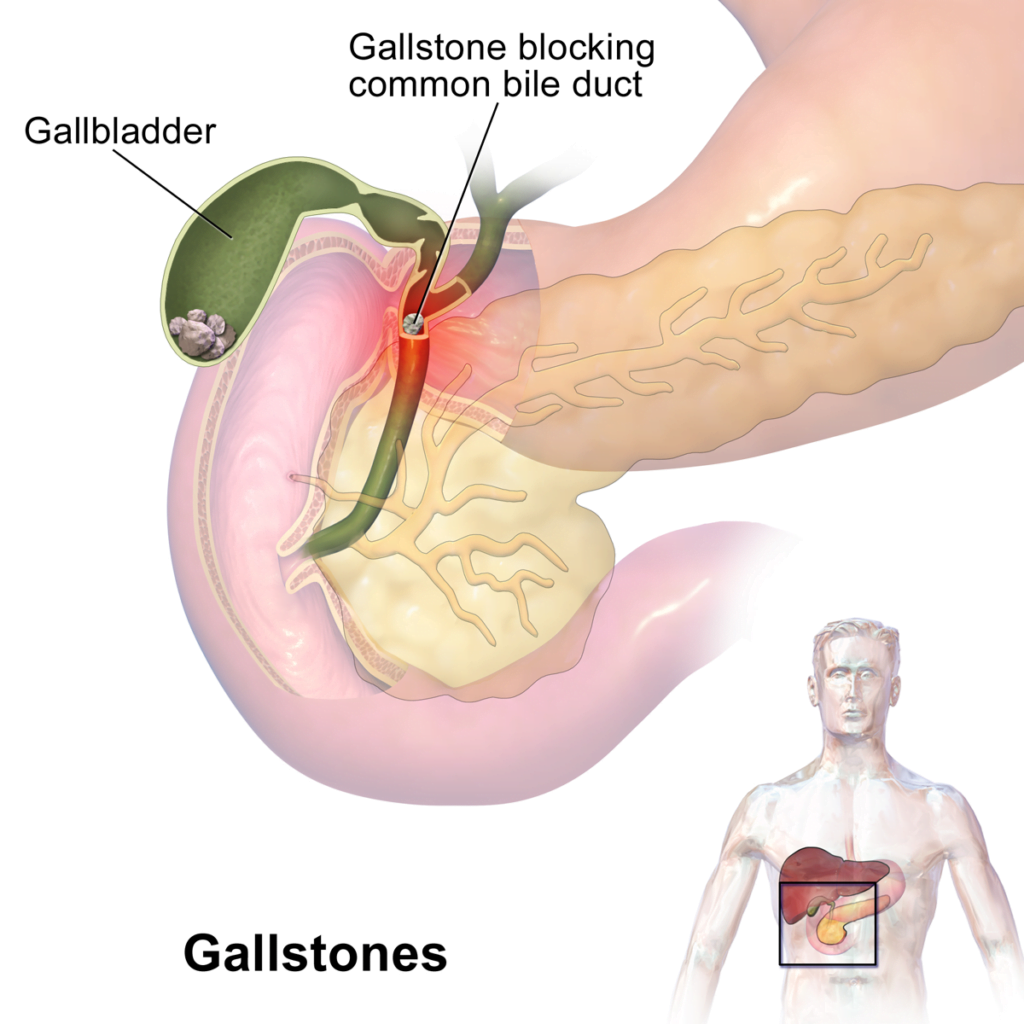 Gallstones Treatment in Bengali