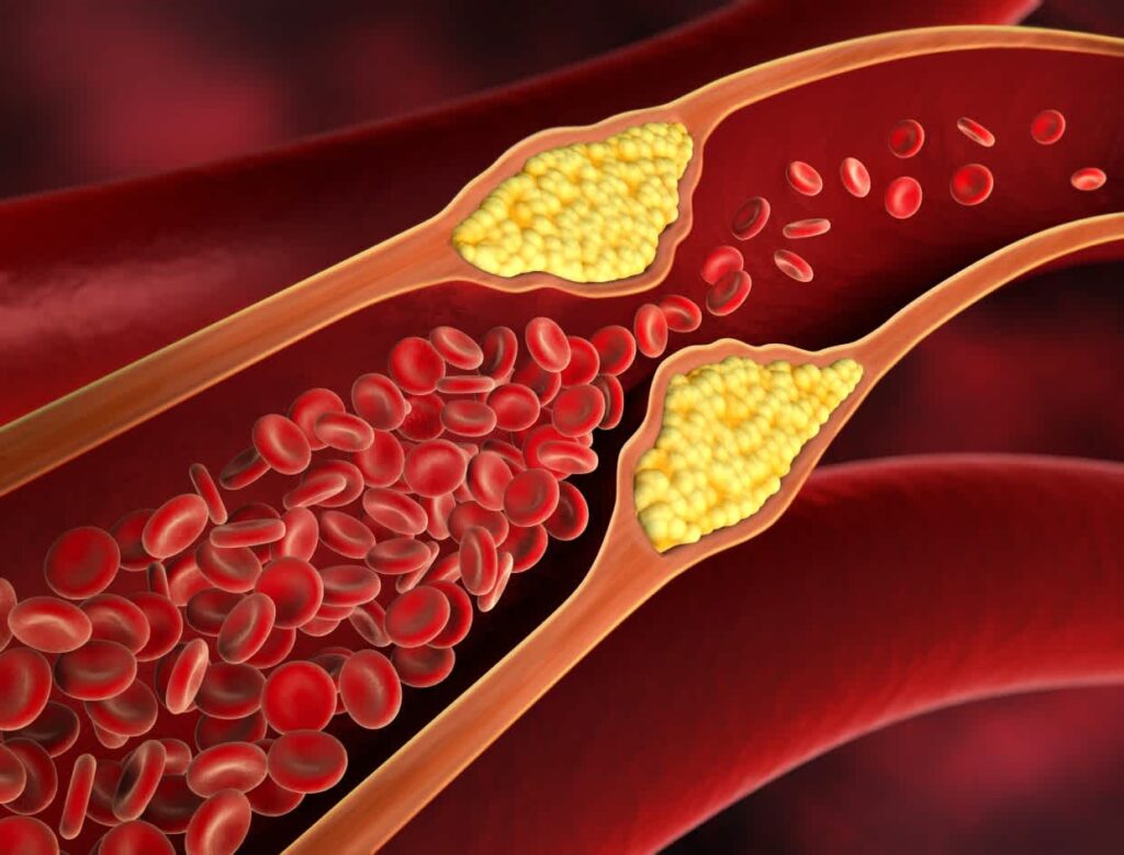 Signs & Symptoms Of High Cholesterol
