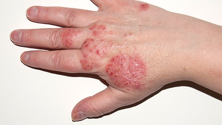 Knock Out Skin Diseases