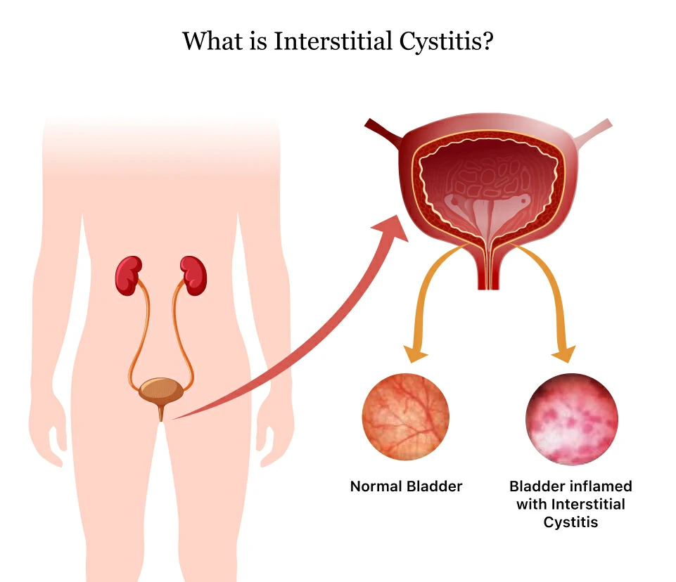 interstitial cystitis