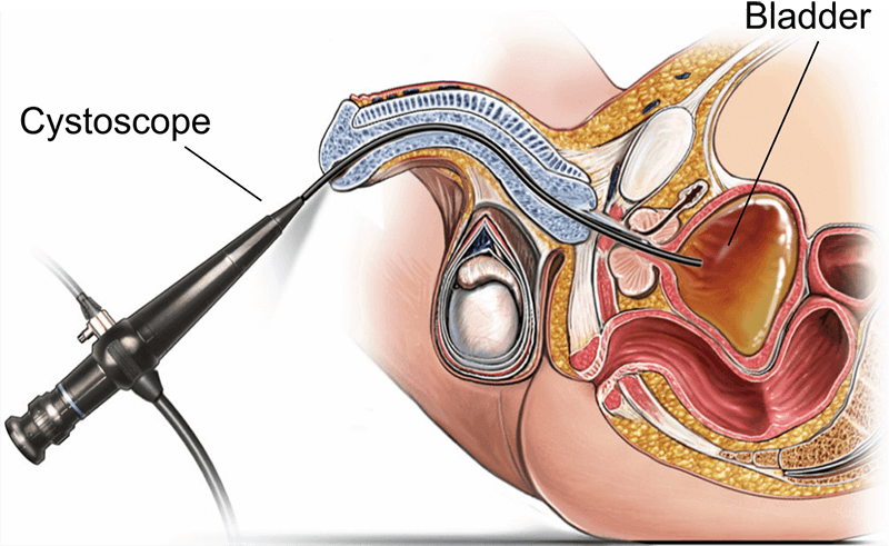 Cystoscopy